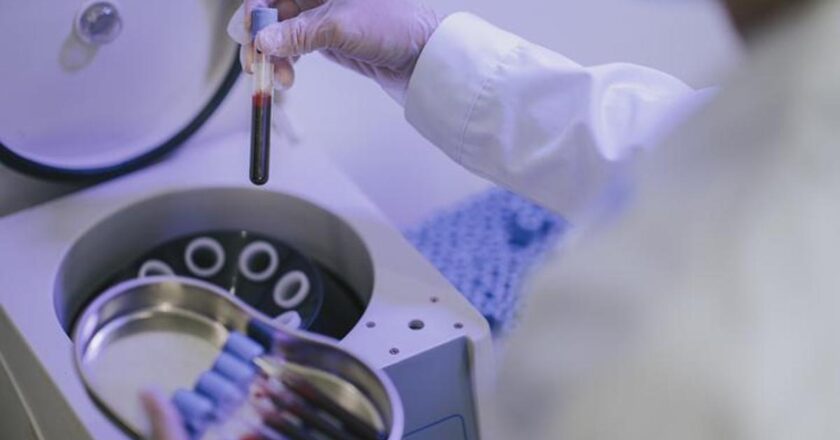 PRP tedavisi nedir, nasıl yapılır? PRP tedavisi çalışıyor mu?